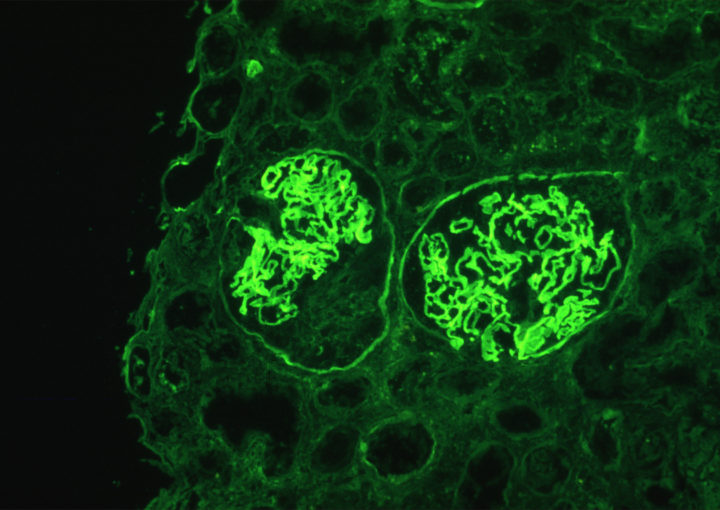 membranous glomerulopathy